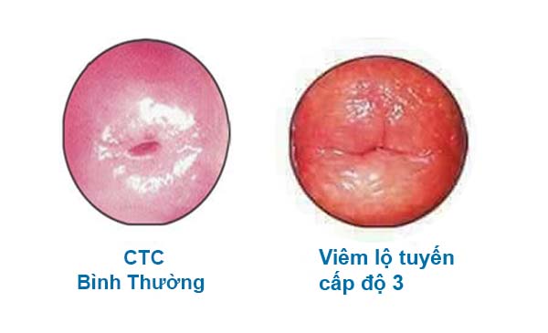 Hình ảnh viêm lộ tuyến độ 3