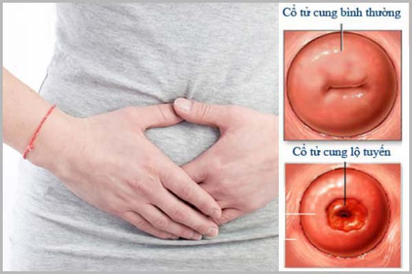 Cách chữa viêm lộ tuyến tốt nhất