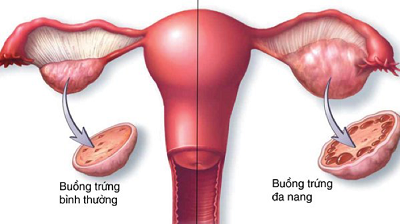 Nguyên nhân gây mất kinh nguyệt