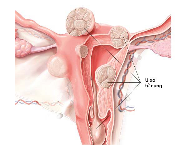 U xơ tử cung có nên mổ không