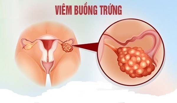 Viêm buồng trứng