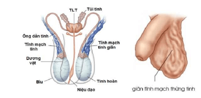 giãn tĩnh mạch thừng tinh