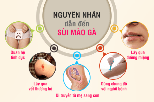 Những nguyên nhân gây ra bệnh sùi mào gà