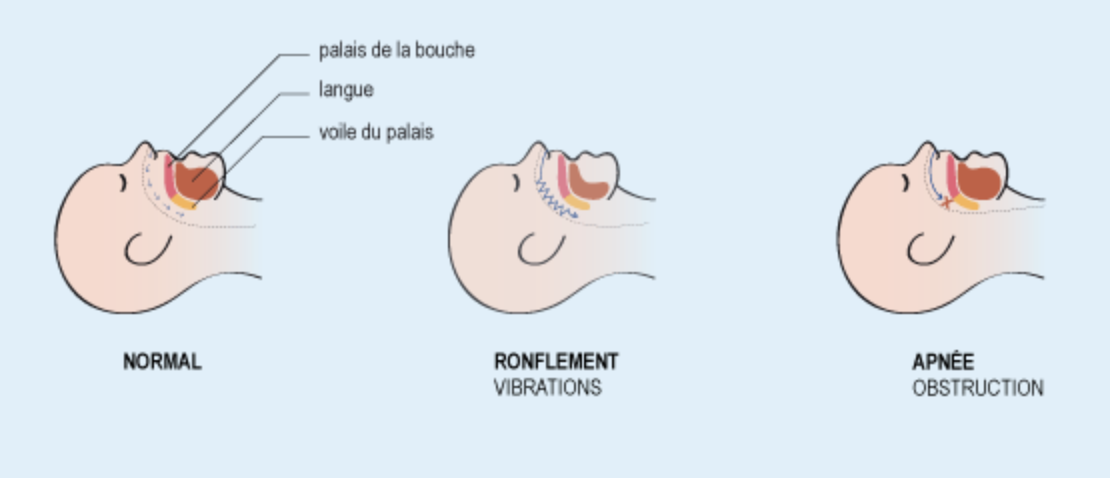 Explication schématique du ronflement et de l'apnée du sommeil
