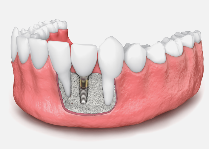 Bone Grafting image