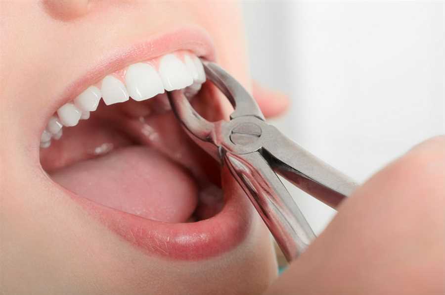 Tooth Extraction image