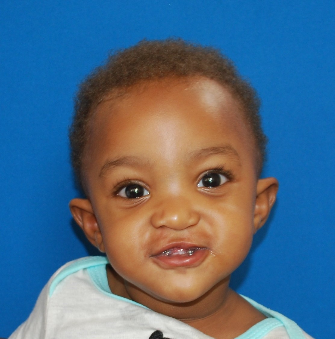 Craniofacial Surgery — Dr. Judy Ward - Board Certified Plastic Surgeon