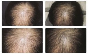 Tinh dầu bưởi mọc tóc có tốt không?