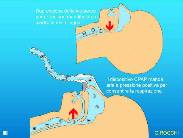 dispositivo CPAP per smettere di russare