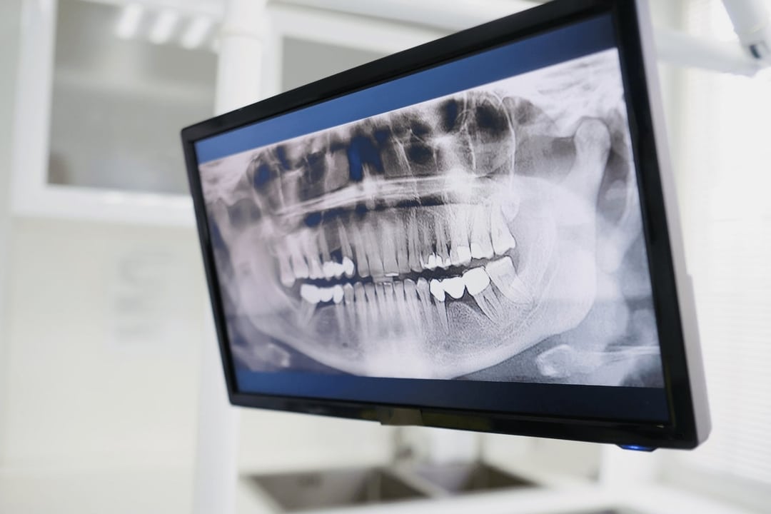 Are Dental XRays Safe? Flossy