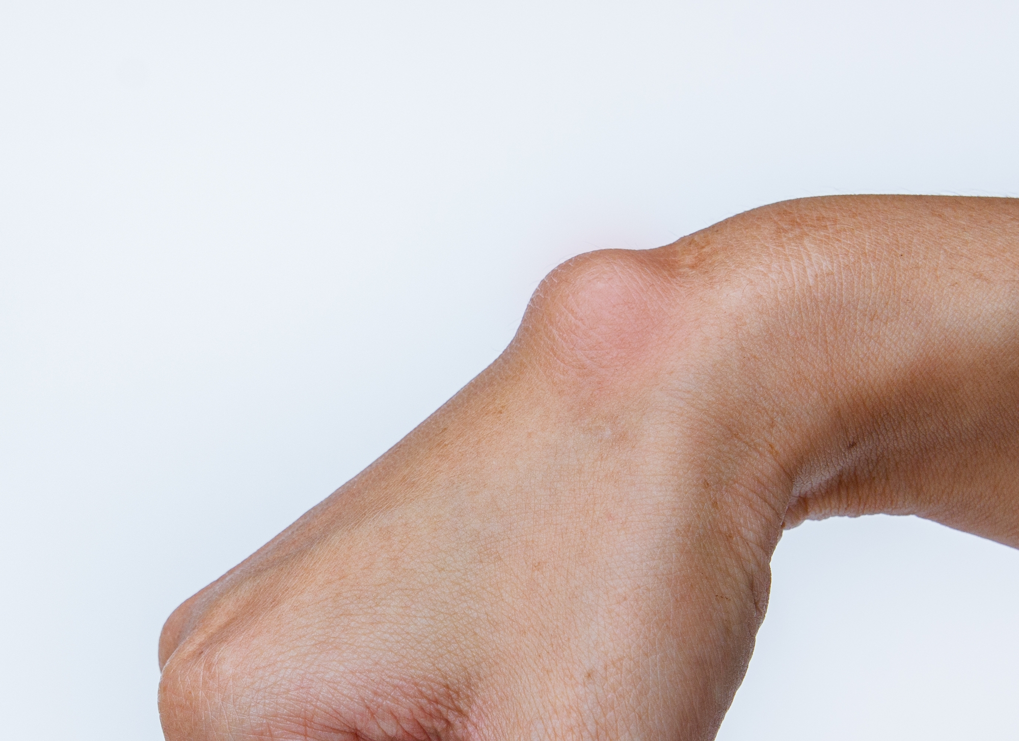 Lipoma Removal Toronto Lipoma Surgery