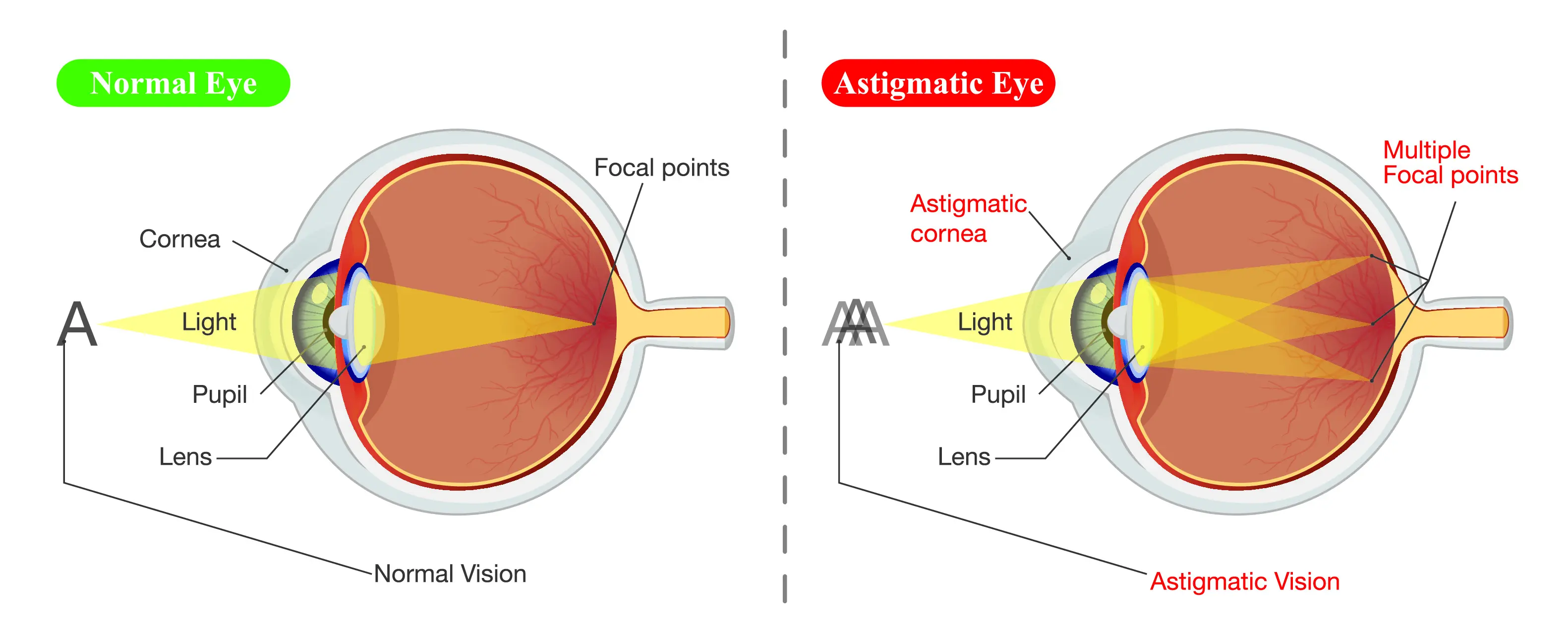 Astigmatism Treatment In Chicago IL Kraff Eye Institute