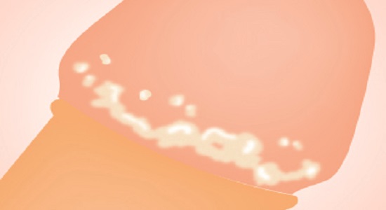 Những bệnh lý từ dấu hiệu dương vật có bựa trắng kèm mùi hôi - Đa Khoa Hồng Phúc Biên Hòa