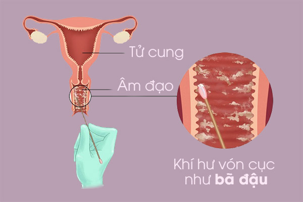 Ra khí hư màu trắng đục như bã đậu là bệnh gì?