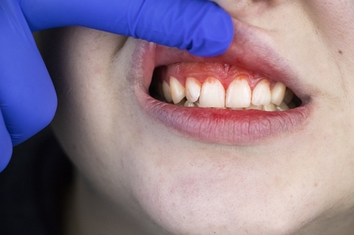 If You Are Dealing With Chronic Bleeding Gums, You Are Not Alone