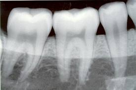 Partial X-ray of Teeth