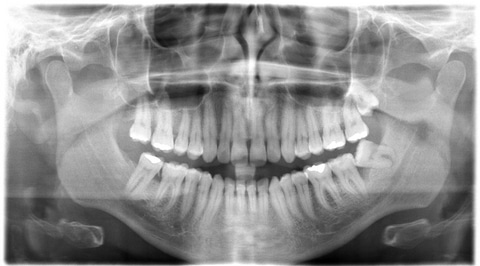 Full X-ray of Teeth