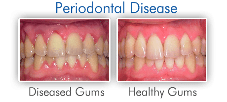 The causes of Periodontal Disease can be diagnosed by a dentist