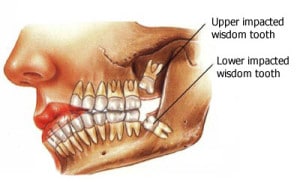 Wisdom tooth diagram