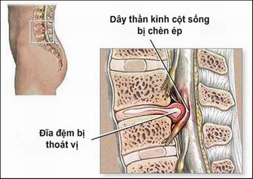 Hình ảnh thoát vị đĩa đệm.