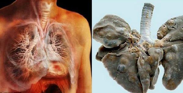 Sán lúc nhúc trong phổi thanh niên 19 tuổi vì món ăn nhiều người Việt thích - 1