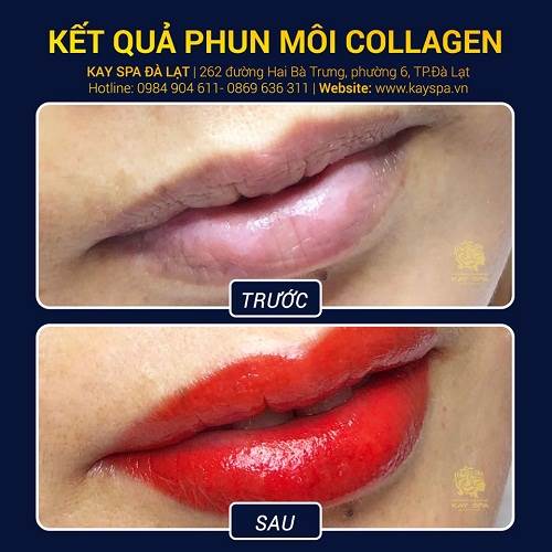 Phun môi Collagen tại Kay Spa Đà Lạt