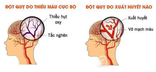 Bệnh tai biến mạch máu não (đột quỵ)