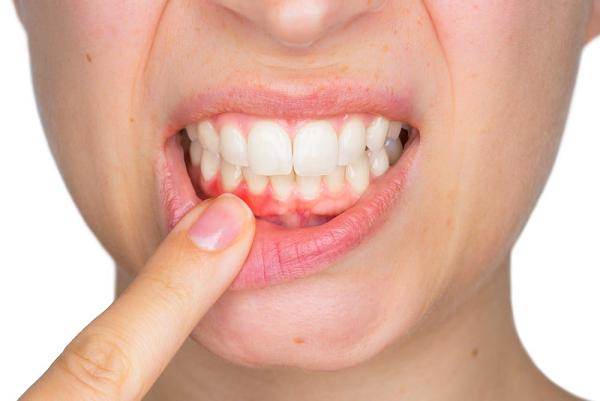 Đường có thể gây ra bệnh nướu răng, có thể dẫn đến bệnh tim
