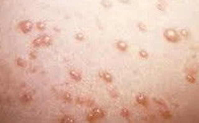Những dấu hiệu mắc bệnh lây qua đường tình dục dễ bị bỏ qua