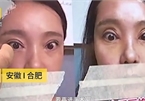 Thê thảm cô gái không thể nhắm mắt sau khi phẫu thuật cắt mí