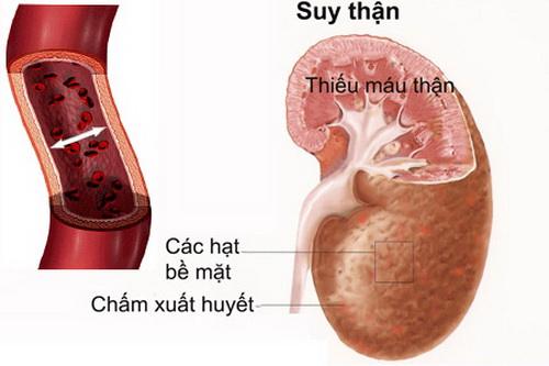 Dùng thuốc theo chỉ định của bác sĩ để tránh hại thận.