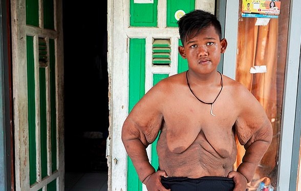 Hình ảnh không ngờ sau giảm cân của cậu bé nặng gần hai tạ