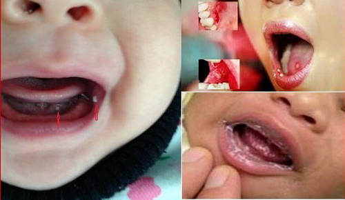 Nấm miệng ở trẻ do Candida.