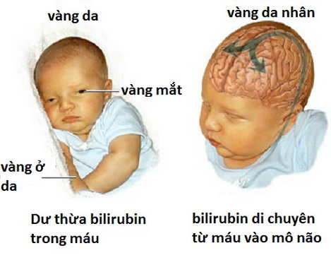 Những biểu hiện khi trẻ mắc bệnh gan.