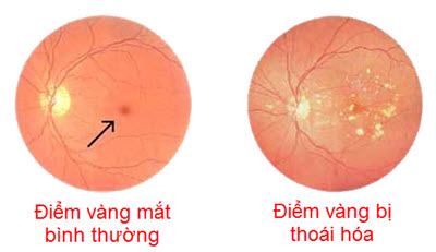 Hút thuốc ảnh hưởng đến sức nhìn như thế nào?