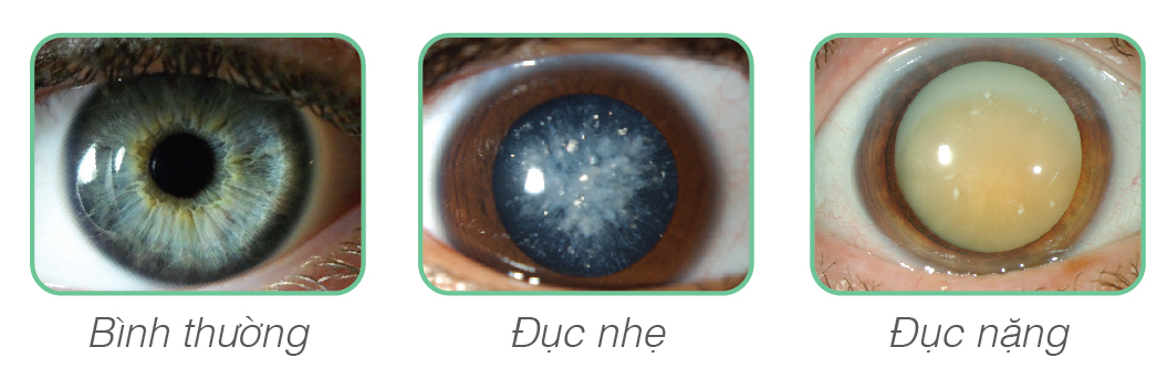Hút thuốc ảnh hưởng đến sức nhìn như thế nào?
