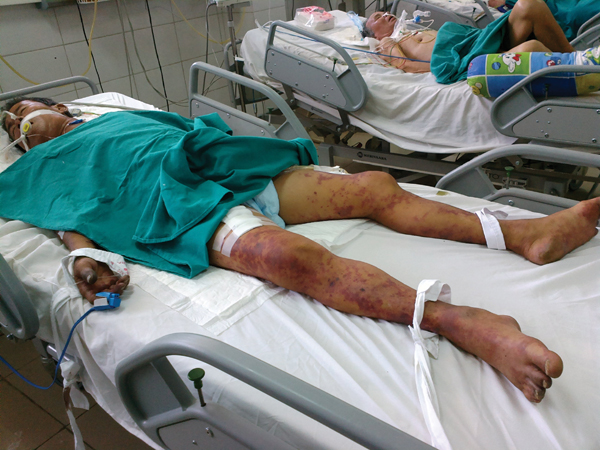 bệnh liên cầu lợn