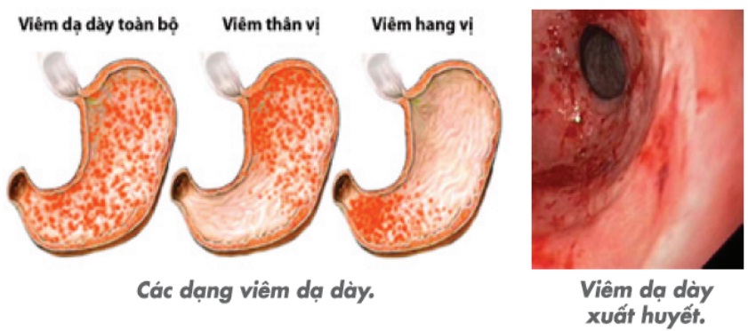 Viêm - loét dạ dày
