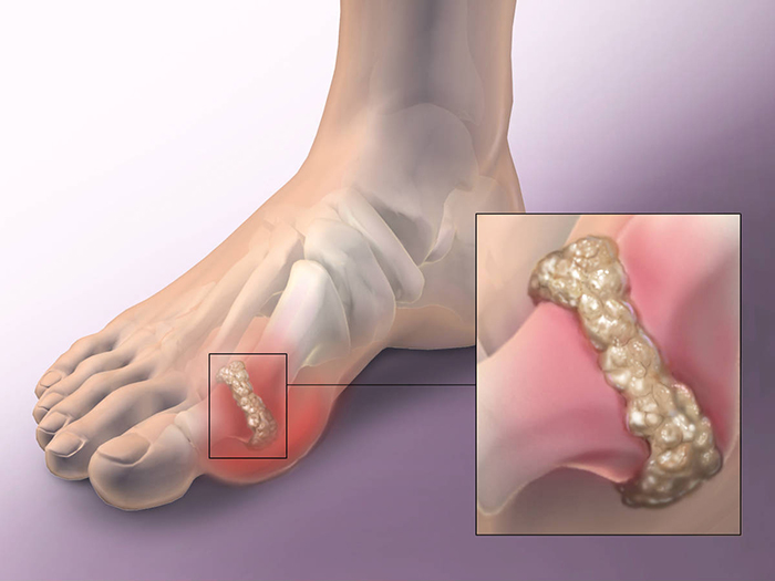 Những sai lầm hay gặp trong điều trị gút