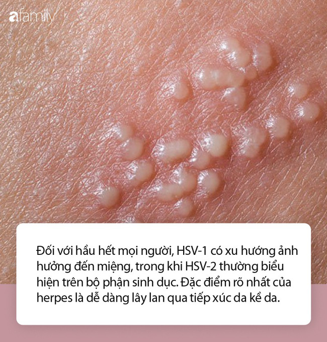 Những nhầm tưởng về mụn rộp sinh dục herpes mà không ít phụ nữ mắc phải - 1