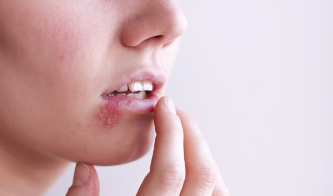 Những nhầm tưởng về mụn rộp sinh dục herpes mà không ít phụ nữ mắc phải
