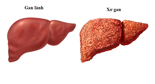 Giảm cân bằng cách ăn hoa quả sấy, người phụ nữ nhập viện vì xơ gan