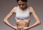 Suốt 3 năm tự móc họng sau ăn để giảm cân, cô gái trẻ chịu kết đắng