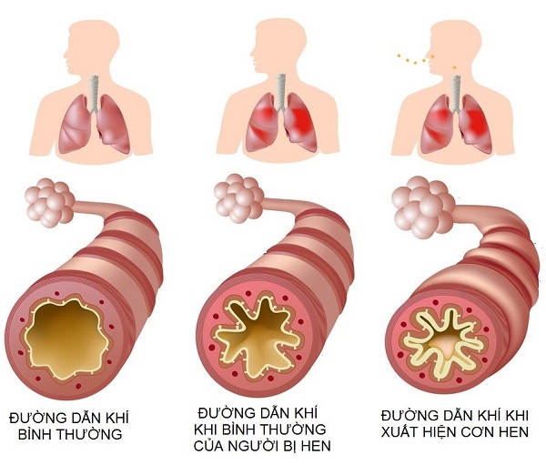 Hen là một bệnh viêm mạn tính của đường hô hấp.