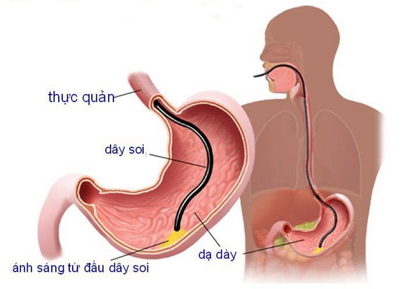 Hình minh họa nội soi dạ dày- tá tràng.