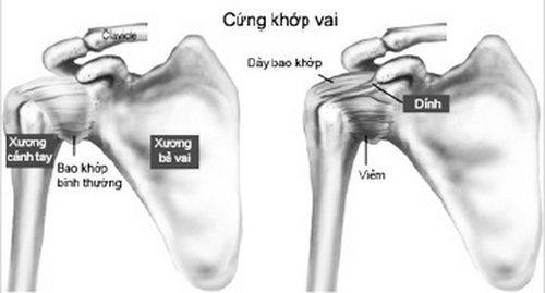 Hình ảnh cứng khớp vai.