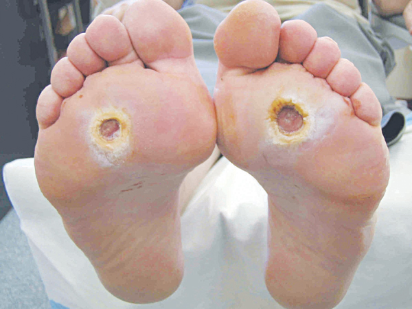 Phòng ngừa biến chứng của bệnh đái tháo đường