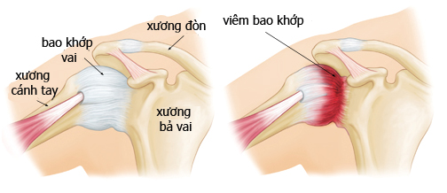 Viêm quanh khớp vai