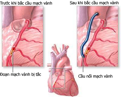 Những nguy cơ gặp phải khi bị cầu cơ động mạch vành