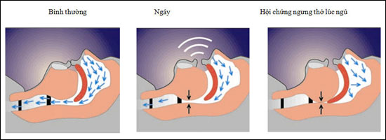 Ngáy và hội chứng ngừng thở khi ngủ có nguy hiểm?
